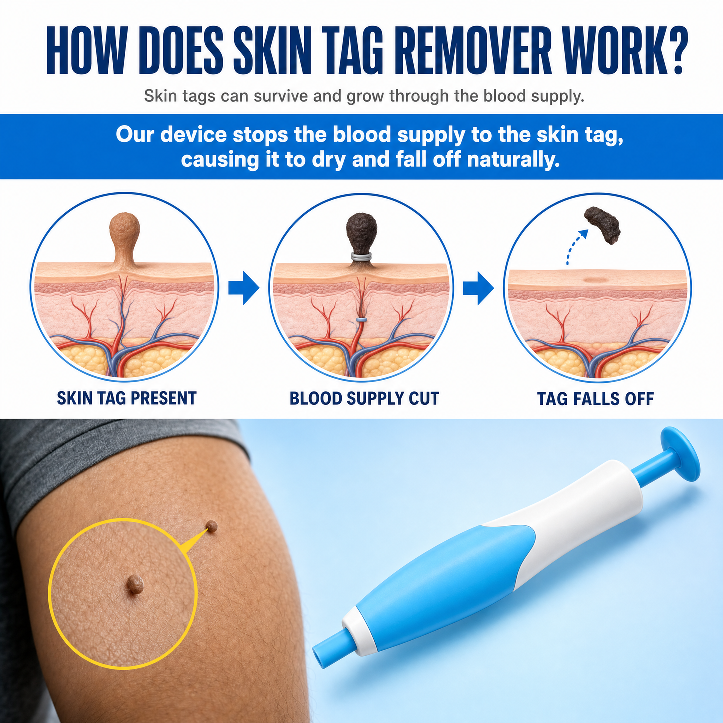 Dervalon™ Skin Tag Removal Kit
