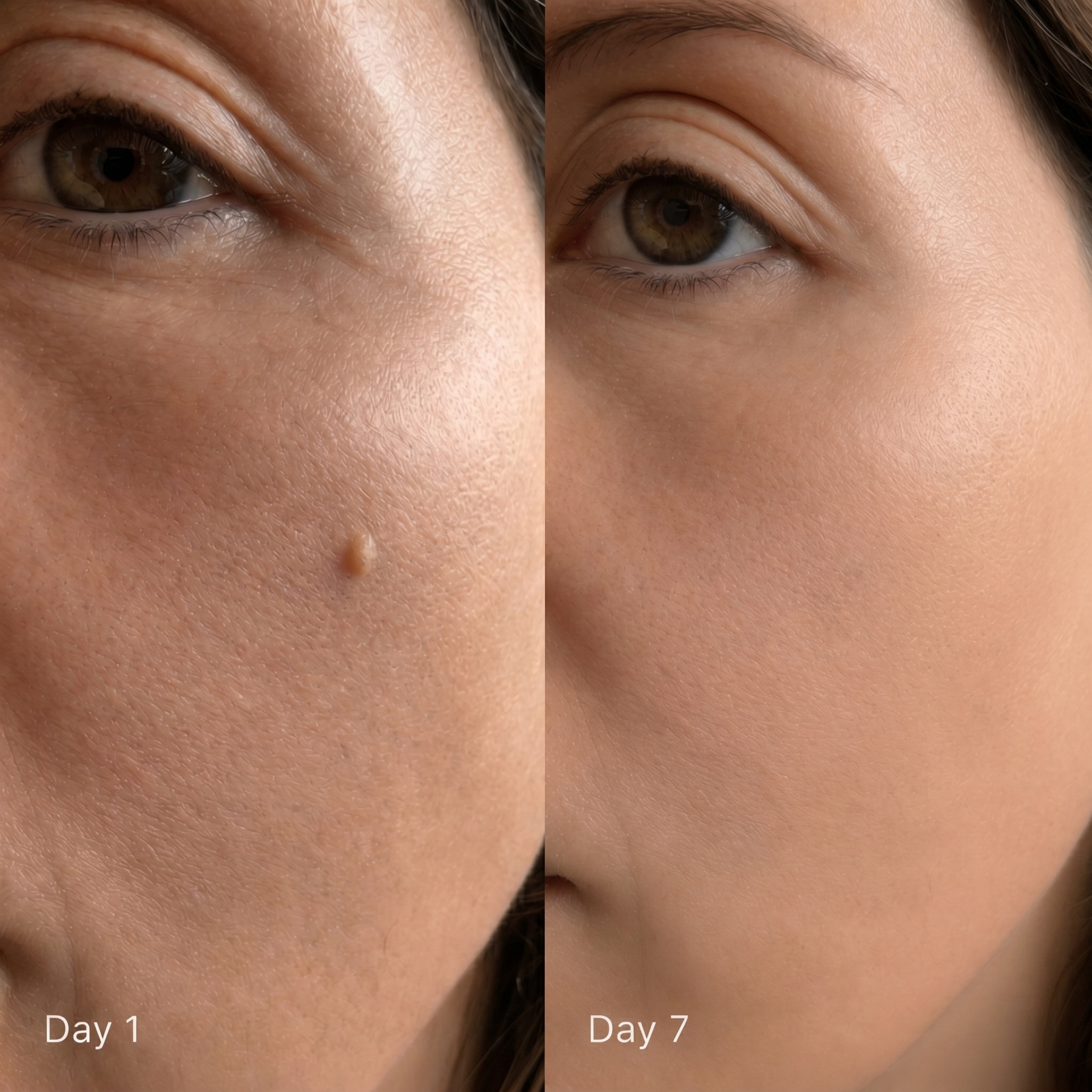 Dervalon™ Skin Tag Removal Kit